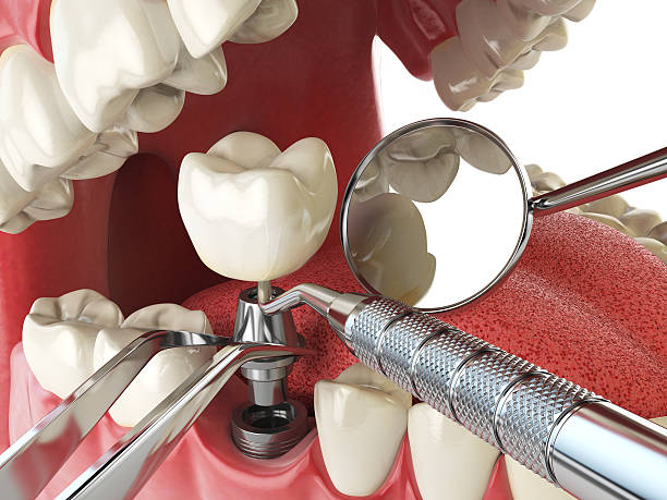 Best Emergency Root Canal Treatment in Victor, ID